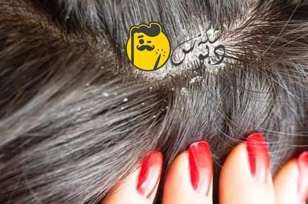4 نصائح للتخلص من قشرة الشعر