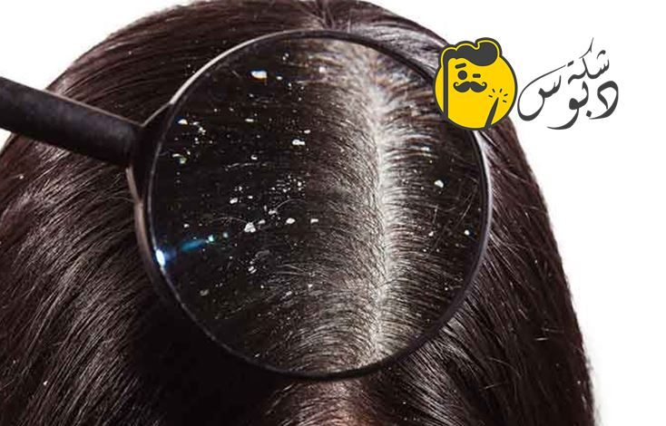 نصائح مهمه لعلاج قشرة الشعر