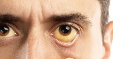 أعراض سرطان البنكرياس.. منها اصفرار بياض العين والجلد