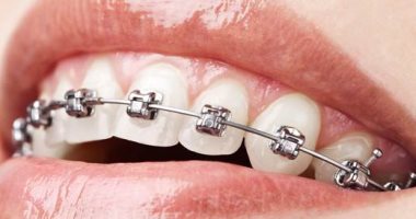 تقويم الأسنان للبالغين.. تعرف على المضاعفات والمخاطر التي تنطوي عليها